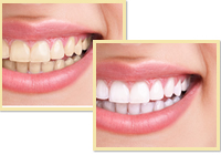 歯を白くキレイにしたい?審美治療